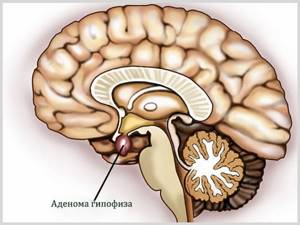 Аденома гипофиза: причины и виды заболевания, сопутствующие признаки, методы терапии и возможные последствия