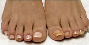 Лечение грибка ногтей народными средствами: причины возникновения и рейтинг лучших рецептов для домашнего использования, советы докторов