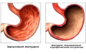 Гастрит желудка: симптомы заболевания, схема лечения и правила питания при повышенной и пониженной кислотности