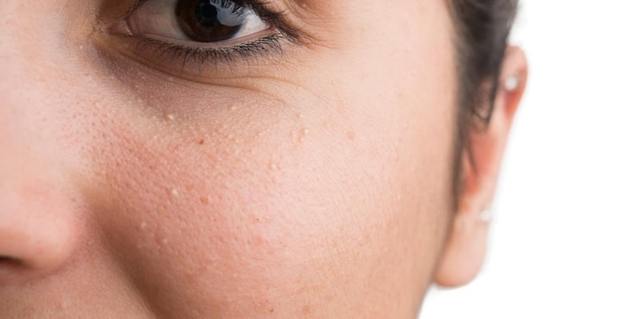 Милиумы на лице: причины появления, характерные признаки, способы лечения и советы по профилактике