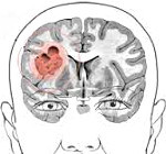 Глиома головного мозга: симптомы и признаки заболевания, методы лечения и вероятность операции, советы врачей