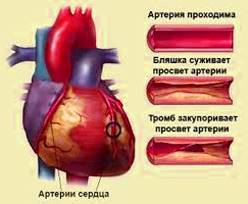 Ишемическая болезнь сердца: классификация и причины возникновения, группы риска и возможные осложнения, методы терапии