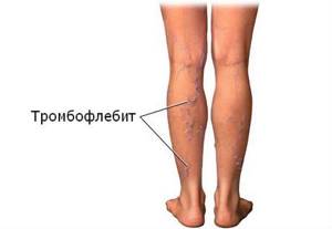 Варикозное расширение вен на ногах: причины появления и первые признаки патологии, разновидности заболевания и стадии развития, методы диагностики и варианты лечения, возможные осложнения