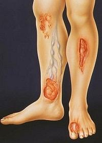 Трофическая язва на ноге в начальной стадии: причины возникновения, характерные проявления, меры диагностики и способы лечения