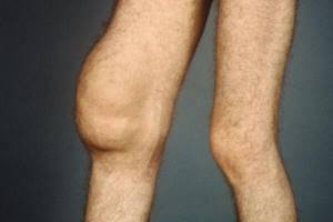 Синовит коленного сустава: классификация и формы заболевания, способы лечения, прогноз и профилактика