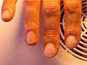 Грибок ногтей на руках: первые признаки и симптомы развития заболевания, современная диагностика и лечение болезни