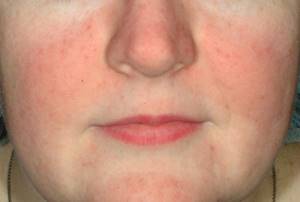 Розацеа на лице: причины появления, формы и стадии заболевания, характерные симптомы и методы лечения патологии, особенности питания при дерматозе