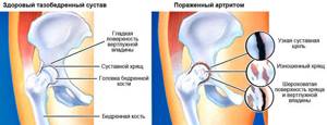 Артрит тазобедренного сустава: причины заболевания, характерные признаки, методы терапии и профилактика