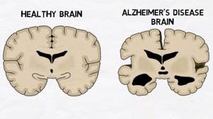 Болезнь Альцгеймера: причины возникновения, формы болезни и факторы риска, лечение и профилактика