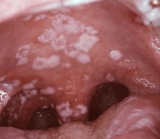 Кандидоз полости рта: причины заболевания, сопутствующие признаки и методы лечения