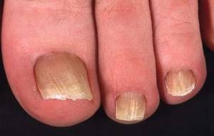 Что такое онихомикоз ногтей и как его лечить: провоцирующие факторы и типичные симптомы заражения, классификация патологии, методы лечения в домашних условиях аптечными препаратами и народными средствами
