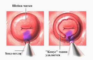 Дисплазия шейки матки 3 степени: общие сведения о заболевании и причины возникновения, методы терапии и вероятность операции