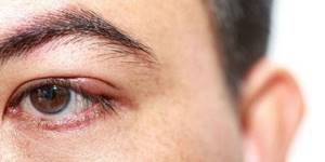 Лечение ячменя на глазу за 1 день в домашних условиях: лучшие препараты и народные рецепты