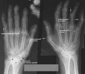 Схема лечения артрита пальцев рук: признаки и виды заболевания, диагностика и профилактика болезни