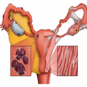 Симптомы гарднереллеза у женщин: основные показания к назначению лечения и способы профилактики заболевания, отзывы пациентов