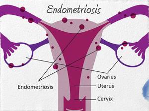 Эндометриоз матки: классификация патологии и ее формы, причины и механизм развития болезни, лечебно-диагностические мероприятия, возможные осложнения и прогноз на выздоровление