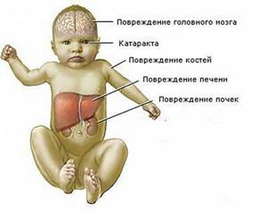 Галактоземия: симптомы у новорожденных, лечение заболевания при помощи медикаментов, осложнения и последствия болезни