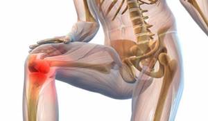 Артроз коленного сустава: симптомы заболевания и схема лечения, обзор эффективных препаратов и отзывы пациентов