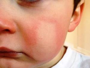 Аллергия на холод, или причина болезни - зима