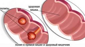 Полипы в кишечнике: происхождение и классификация новообразований, характерные проявления, способы лечения и особенности диеты