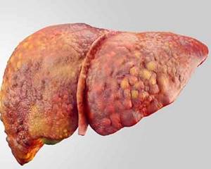Жировой гепатоз: причины возникновения, сопутствующие симптомы, методики лечения и правила питания