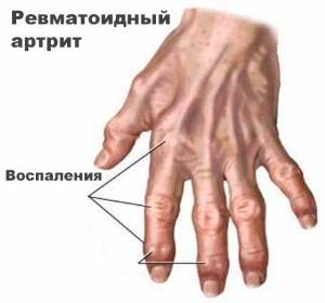 Ревматоидный артрит пальцев рук: клинические симптомы, методы диагностики и специфика течения заболевания, традиционные и народные методы лечения патологии