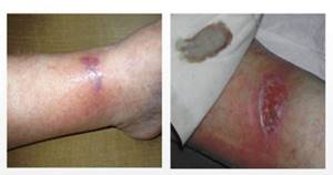 Трофическая язва на ноге в начальной стадии: причины возникновения, характерные проявления, меры диагностики и способы лечения