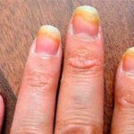 Что такое онихомикоз ногтей и как его лечить: провоцирующие факторы и типичные симптомы заражения, классификация патологии, методы лечения в домашних условиях аптечными препаратами и народными средствами