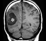 Абсцесс головного мозга: причины возникновения, сопутствующие симптомы, диагностика и лечение