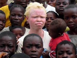 Альбинизм у человека: причины и признаки заболевания, возможные осложнения и профилактические меры