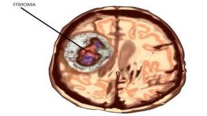 Глиома головного мозга: симптомы и признаки заболевания, методы лечения и вероятность операции, советы врачей
