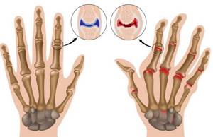 Ревматоидный артрит пальцев рук: клинические симптомы, методы диагностики и специфика течения заболевания, традиционные и народные методы лечения патологии