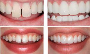 Какие коронки лучше ставить на передние зубы: виды, фото до и после, стоимость