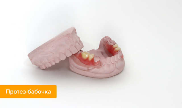Протезирование зубов: виды зубных протезов и мостов, варианты съемных и несъемных, лучшие стоматологические протезы