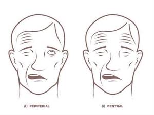 Симптомы и лечение поражений лицевого нерва: неврит (паралич Белла), парез, невралгия, нейропатия и другие