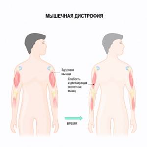 Миопатия Дюшенна (прогрессирующая мышечная дистрофия): симптомы, лечение, последствия