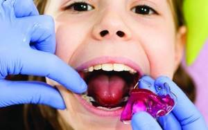 Пластины на зубы: выравнивание зубов у детей и взрослых, фото до и после, сколько носить