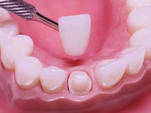 Реставрация зубов: фото до и после восстановления, виды и методы