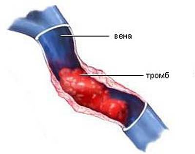 Тромб в руке симптомы: тромбофлебит верхних конечностей, симптомы, лечение
