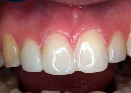 Реставрация зубов: фото до и после восстановления, виды и методы