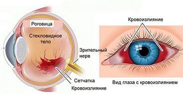 Кровоизлияние в глаз: виды и их отличие, причины, лечение, когда и чем опасно