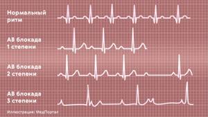 Сердечная блокада: полная и частичная, различных локализаций – причины, признаки, лечение
