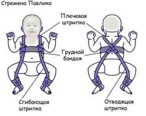 Что такое дисплазия тазобедренных суставов у детей: как проявляется, методы лечения патологии