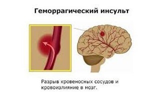 Кровоизлияние в мозг: причины и лечение, признаки острой стадии и симптомы-предшественники, последствия и прогноз