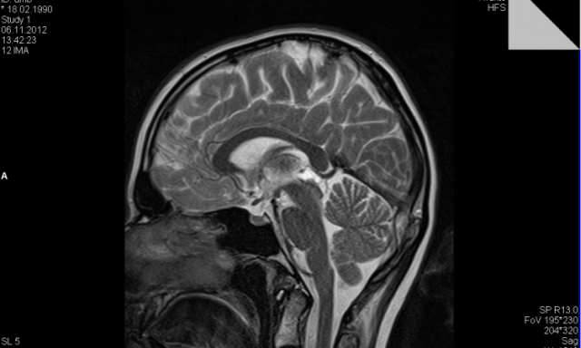 Арахноидальная киста головного мозга - классификация, лечение и последствия образования