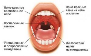На корне языка ближе к горлу красные пупырышки и прыщи: что это, причины появления бугорков, лечение шишек