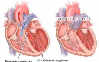 Кардиостимулятор сердца: плюсы и минусы, как проходит операция, жизнь после установки ЭКС