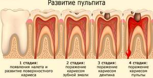 Пульпит молочного зуба у ребенка – симптомы, этапы лечения, профилактика