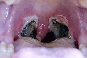 Белые точки на миндалинах и гландах в горле у детей и взрослых, лечение белых образований