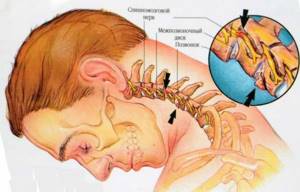 Нарушение венозного оттока (дисциркуляция) головного мозга: причины, симптомы, лечение